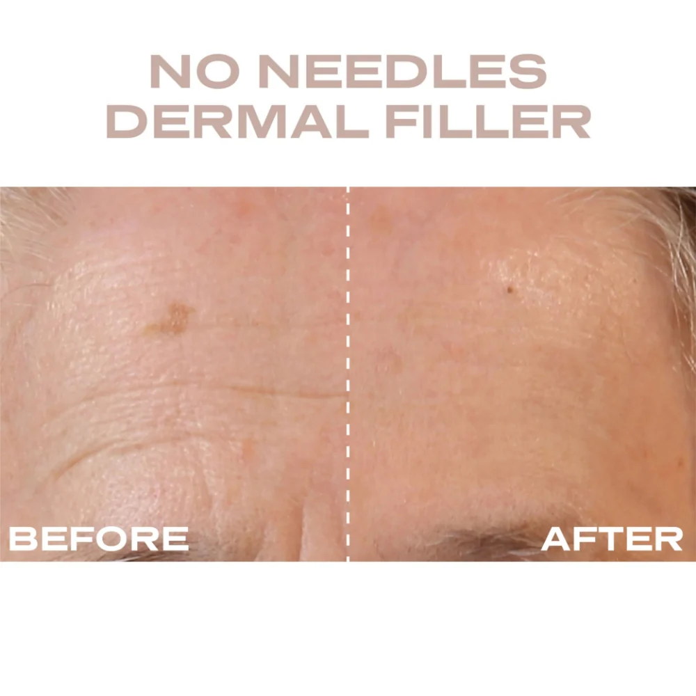 Plump It No Needles Derma Filler Pods Starter Kit 15 x 10ml - Image 9