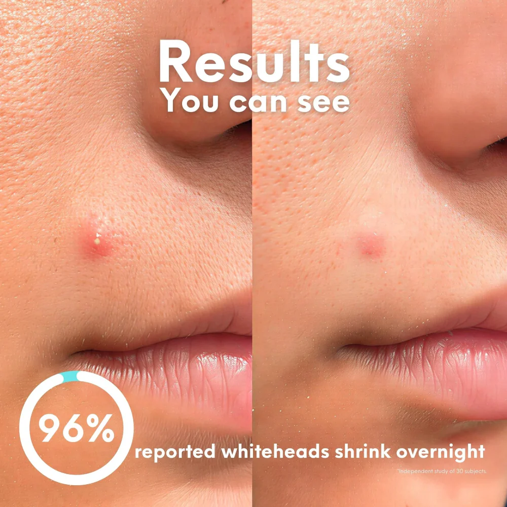 Skin Choice Breakout Classic Acne Spot Pimple Patches x30 - Image 10