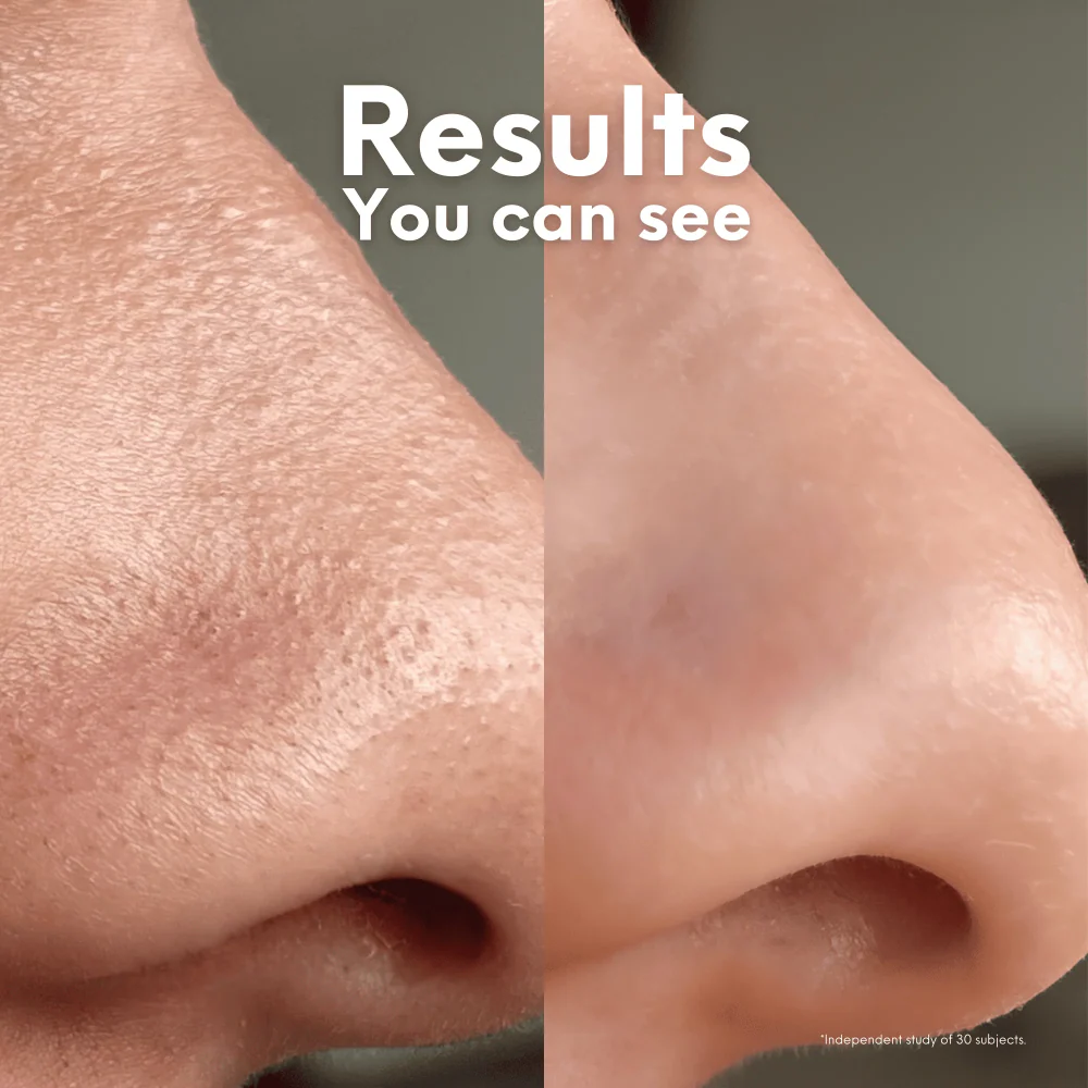 Skin Choice Breakout Classic Nose Hydrocolloid Pore Patches x5 - Image 5